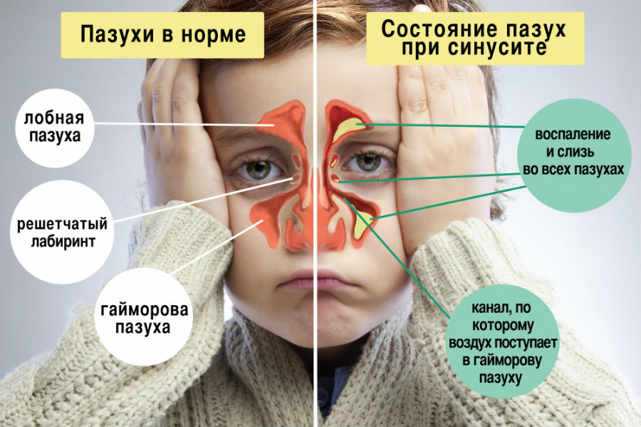 Симптомы синусита Симптомы синусита