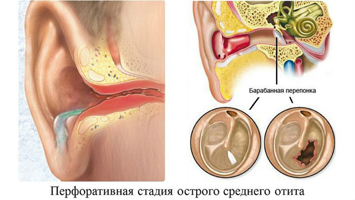 Перфоративный средний отит