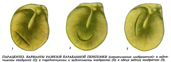 Парацентез