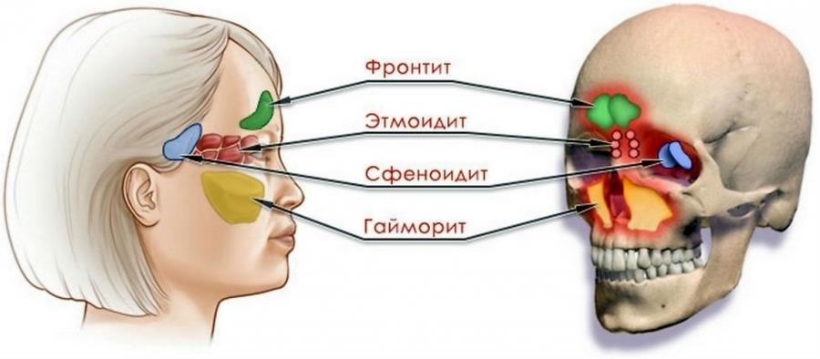 Воспаление пазух носа