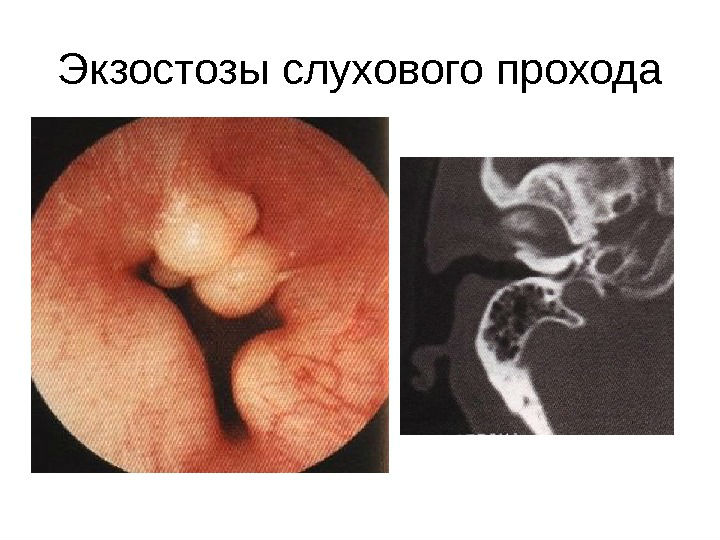 Экзостозы слухового прохода Экзостозы слухового прохода