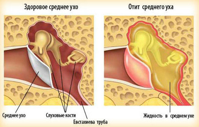 Острый средний отит Острый средний отит