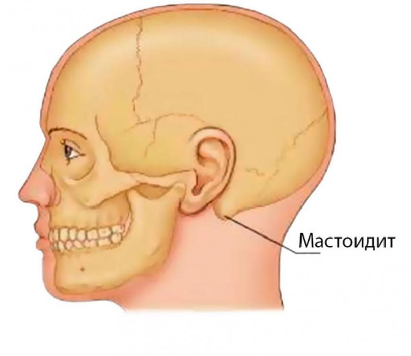 Мастоидит Мастоидит