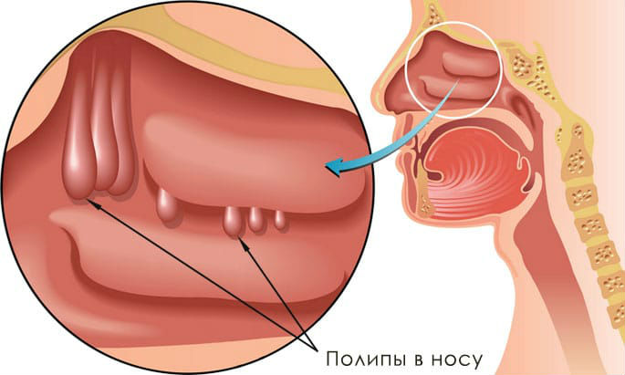 Полипы в носу
