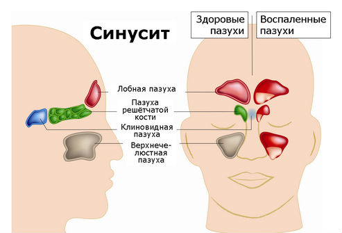 Синусит