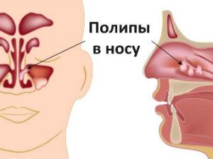 Полипы в носу