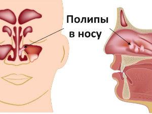 Полипы в носу