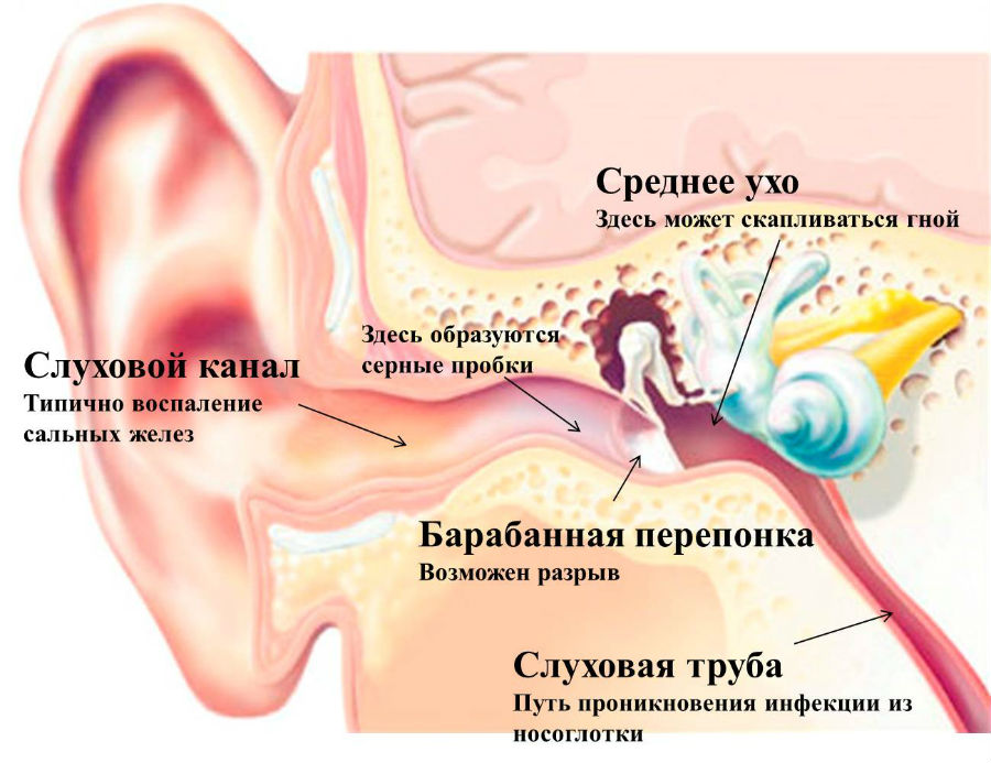 Образование серной пробки Образование серной пробки