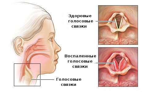 Воспаление голосовых связок Воспаление голосовых связок