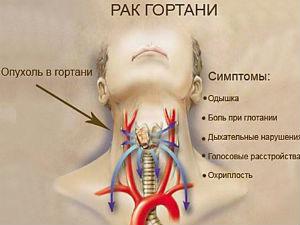 Рак гортани