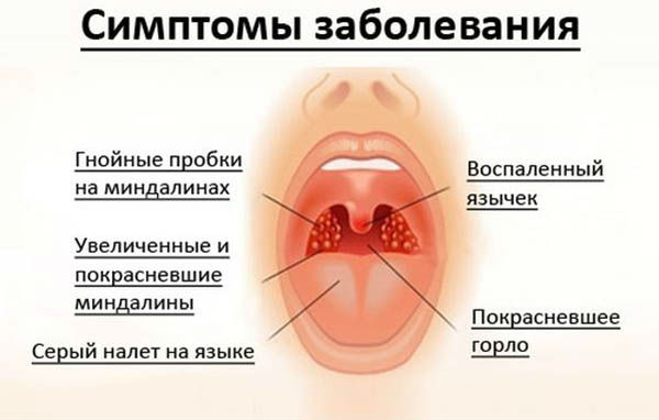 Ангина