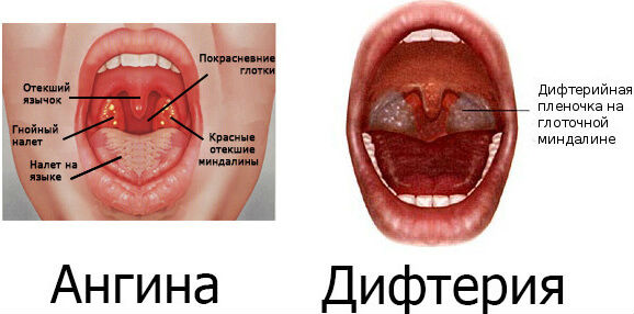 Ангина и дифтерия