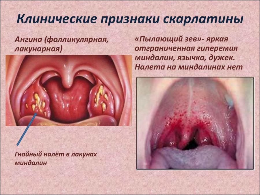 Скарлатина