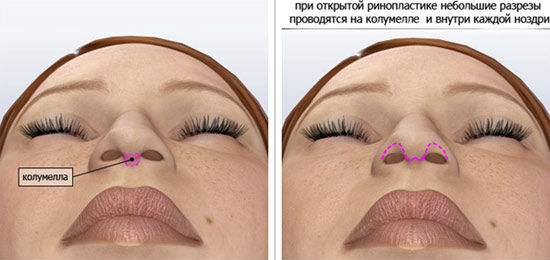 Открытая пластика носа Открытая пластика носа