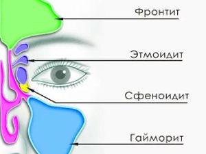 Воспаления пазух носа