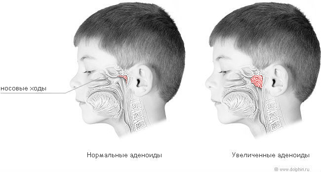 Аденоиды Аденоиды