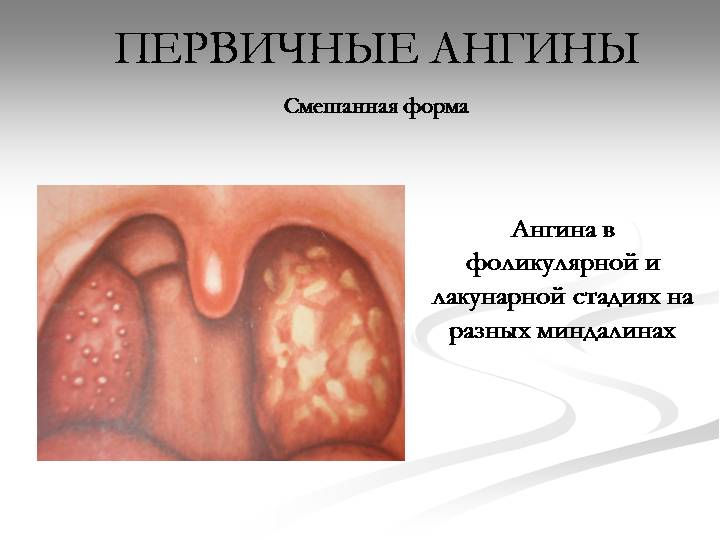 Фолликулярная и лакунарная ангина