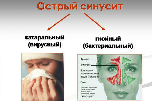 Виды острого синусита