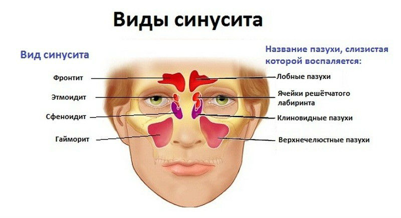 Виды синуситов