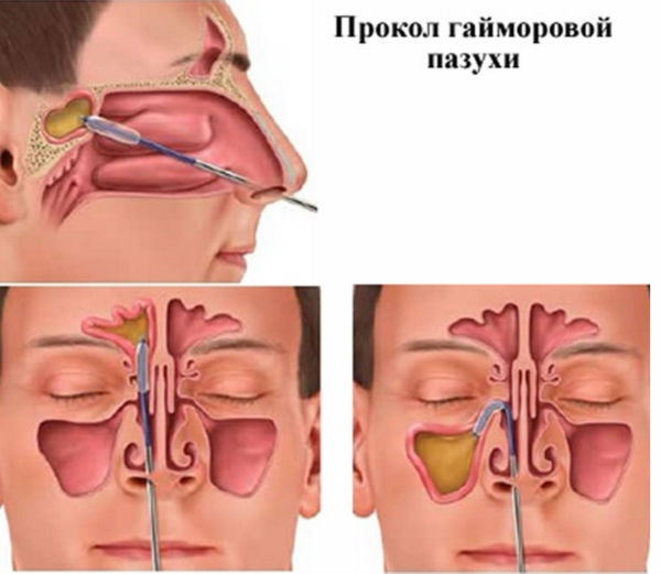 Прокол гайморовой пазухи