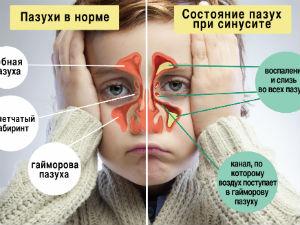 Синусит
