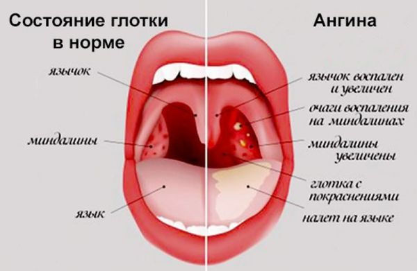 Горло при ангине