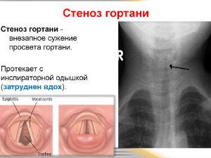 Стеноз гортани