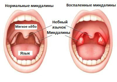 Воспаление миндалин Воспаление миндалин