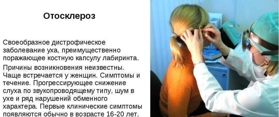 Отосклероз