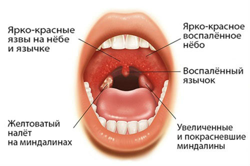 Симптомы ангины