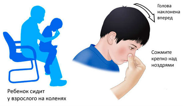 Остановка носового кровотечения