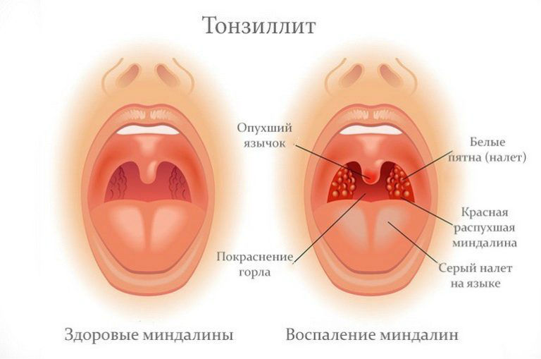 Тонзиллит