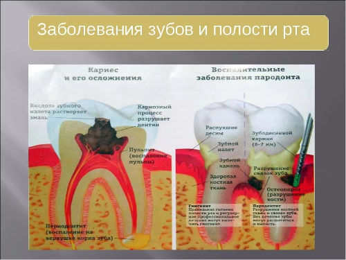 Заболевания зубов