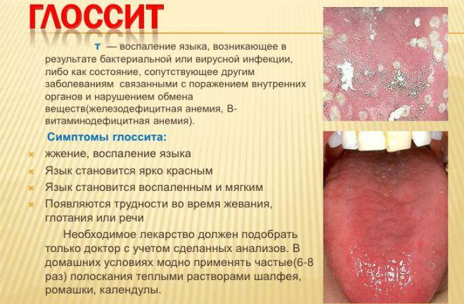 Глоссит