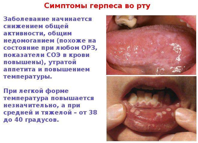 Симптомы герпеса
