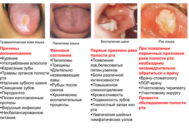 Раковые опухоли во рту