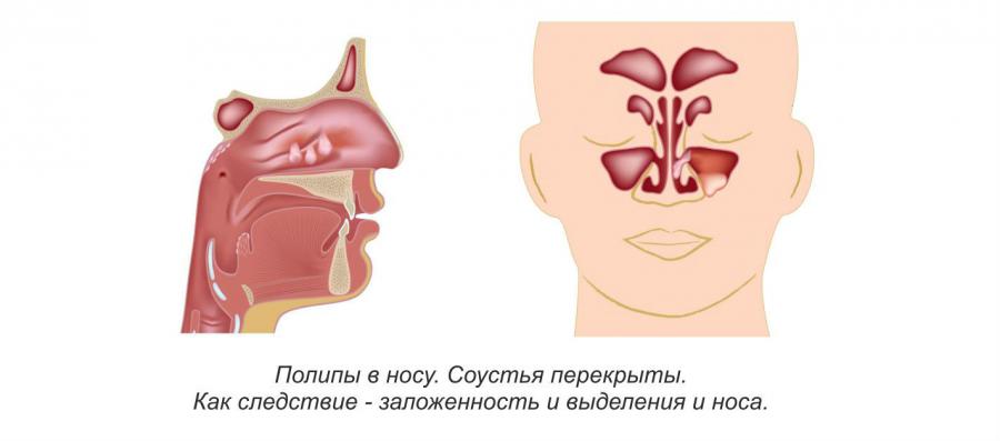Полипы в носу
