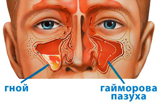 Гайморит